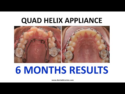 Quad Helix for Arch Expansion - Six Months Result