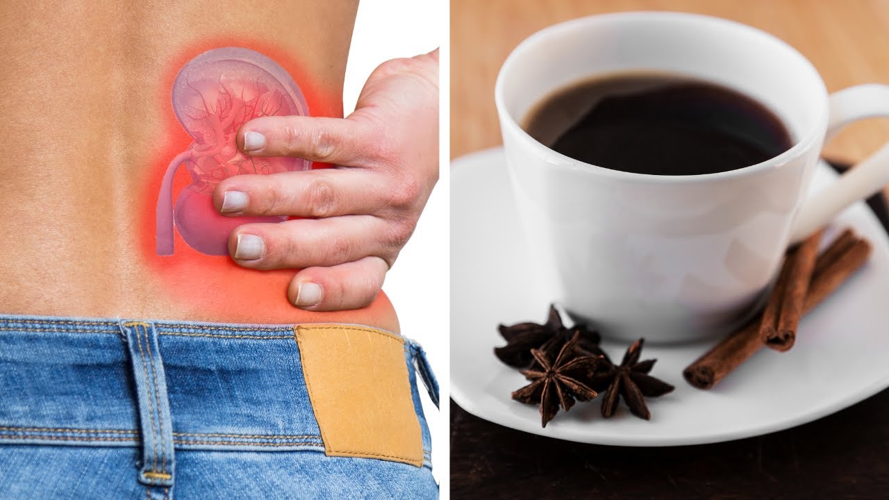 Star Anise Coffee: A Natural And Effective Treatment For Kidney Stones