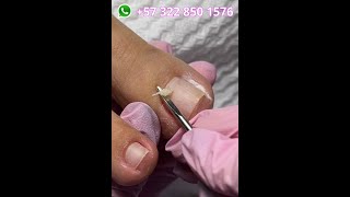 que FACIL es sacar espículas con estas HERRAMIENTAS