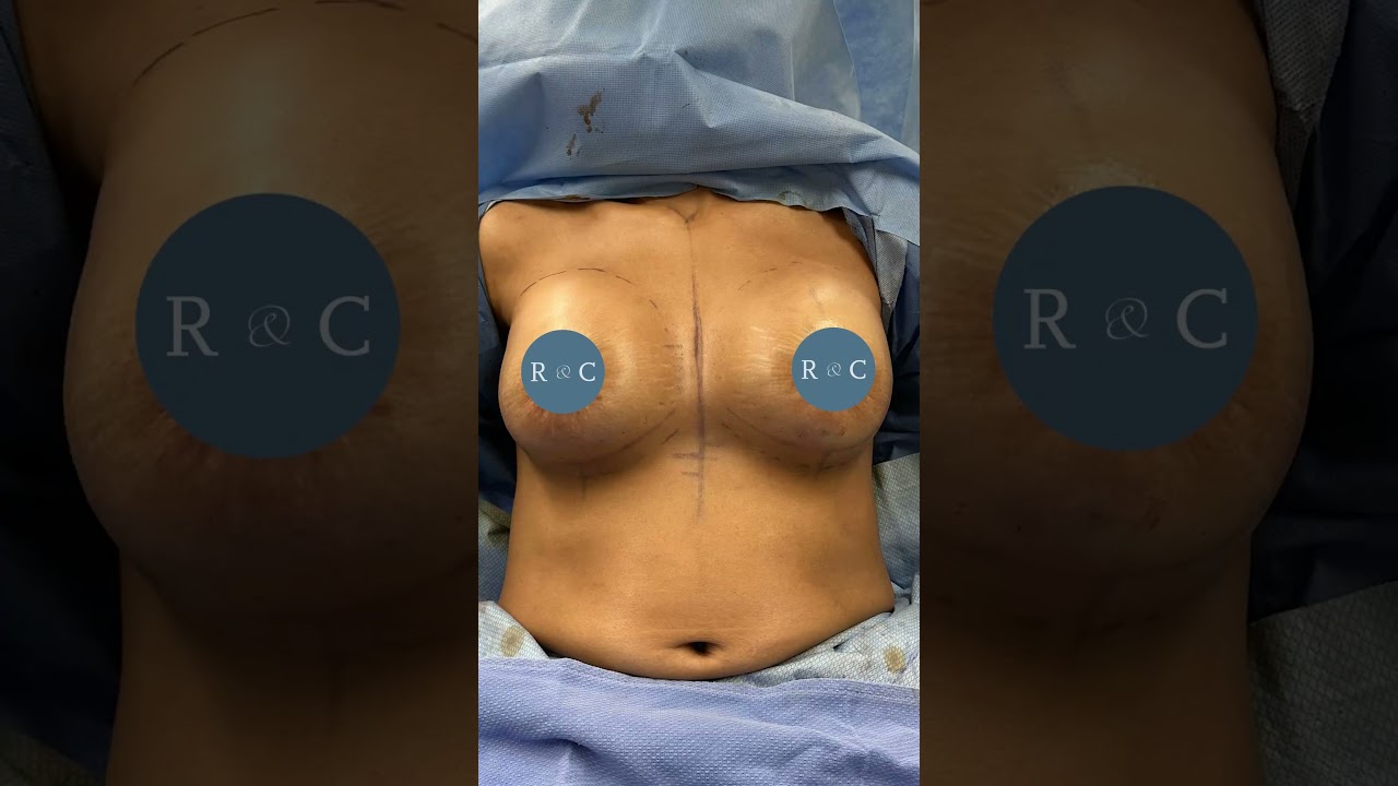 Breast augmentation without implants