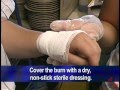 Burn Care and First Aid