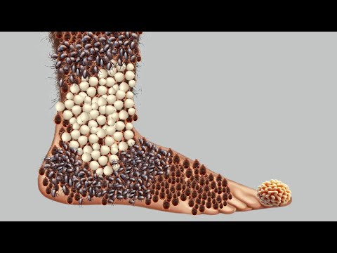 ASMR Animation Treatment | Removal of ticks