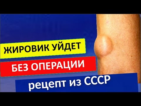 Жировик растает безопасно и просто! Советский способ избавления от липомы!