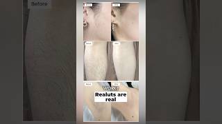 Finally Found It: The Best Hair Removal Device for 2026 #beauty #skincare