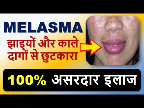 झाइयों और काले दागों से छुटकारा | Melasma का 100% इलाज