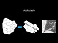 Atelectasis and Its Radiographic Features