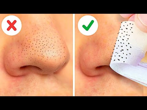 easy way to remove blackhead Whitehead at home remedy| Priya Creations09