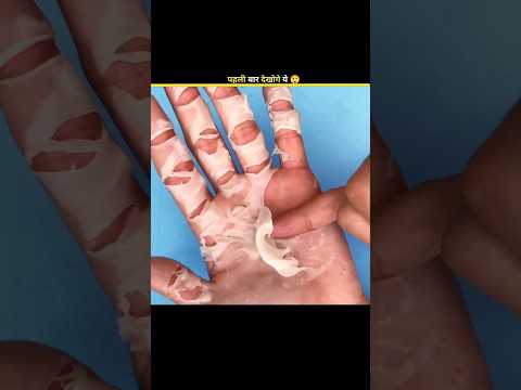 The Truth About Acral Peeling Syndrome 😲 #shorts  #facts   #factoholic