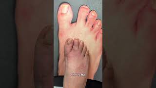 ARE YOU UNHAPPY WITH A “TOE GAP?” DON’T WORRY, WE CAN HELP!☝🏼#shorts #cosmeticfootsurgery
