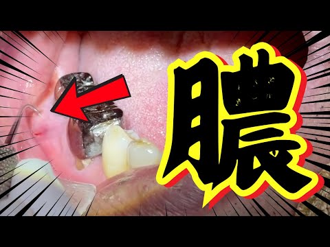 膿がたまって歯医者に駆け込み！応急処置で患者さんを助けます