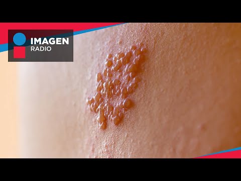 ¿Qué es y cómo se contagia el Herpes Zóster?