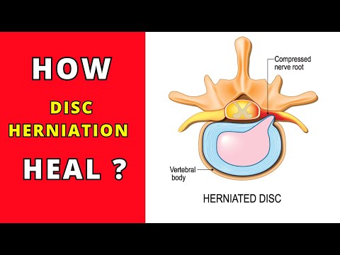 How disc herniation heal without surgery