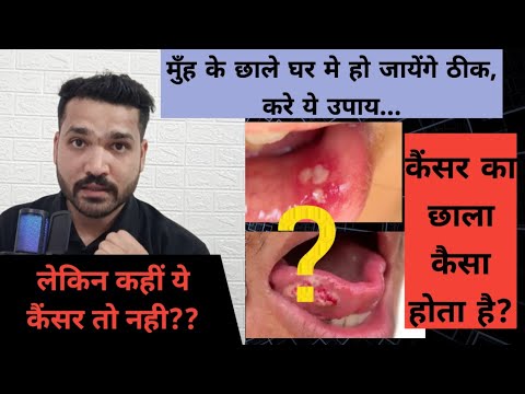 मुँह के छालो के 4 घरेलू ईलाज!  कैसा मुँह का छाला कैंसर हो सकता है ?