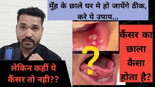 मुँह के छालो के 4 घरेलू ईलाज!  कैसा मुँह का छाला कैंसर हो सकता है ?