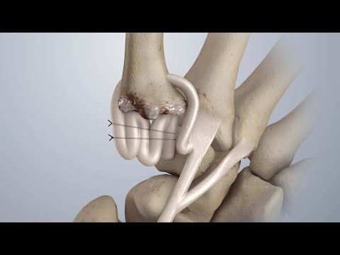 Cirugía para tratar la osteoartritis del pulgar