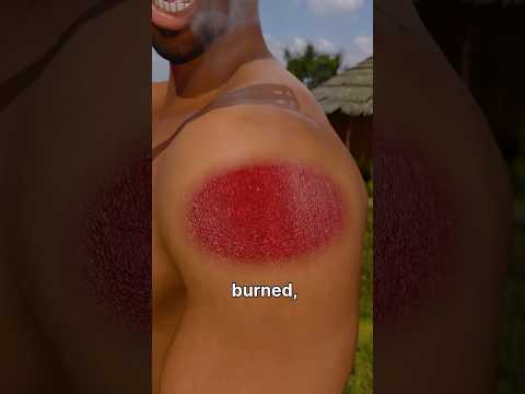 How Skin Transplants Work😲