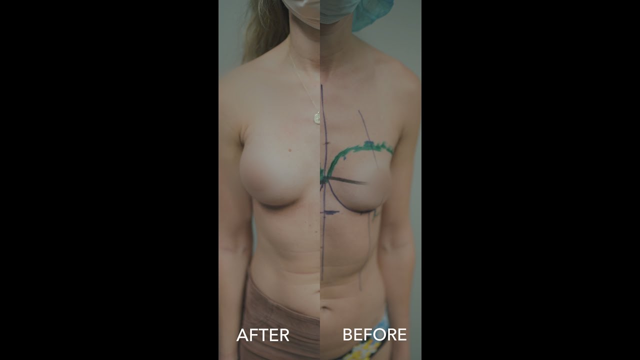 Natural-Look IMF Breast Augmentation | realdrseattle