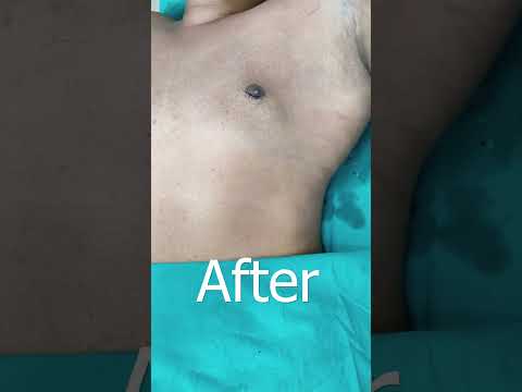 Gynecomastia Surgery #shortvideo #dezireclinicindia