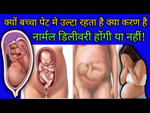 क्यों बच्चा पेट मे उल्टा रहता है क्या reason है अब नार्मल डिलीवरी होंगी या नहीं?
