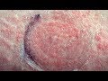 Moisturizer Effects and Skin Health