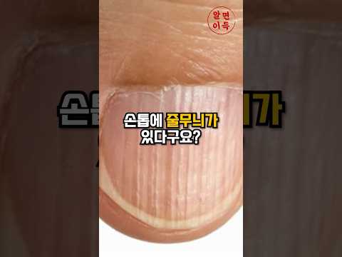 손톱에 세로줄이 있다면?