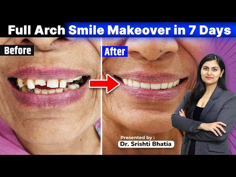 Full Arch Smile Makeover in 7 days: Dr. Srishti Bhatia #smile #smilemakeover #dentist