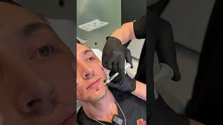 Define, Don’t Inflate: How Threads and Fillers Reshape the Male Face | Dr. Jason Emer