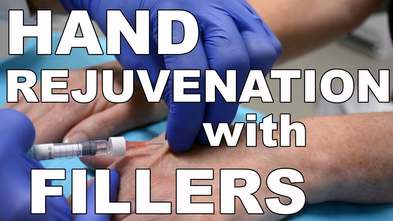 Hand rejuvenation procedure with fillers.