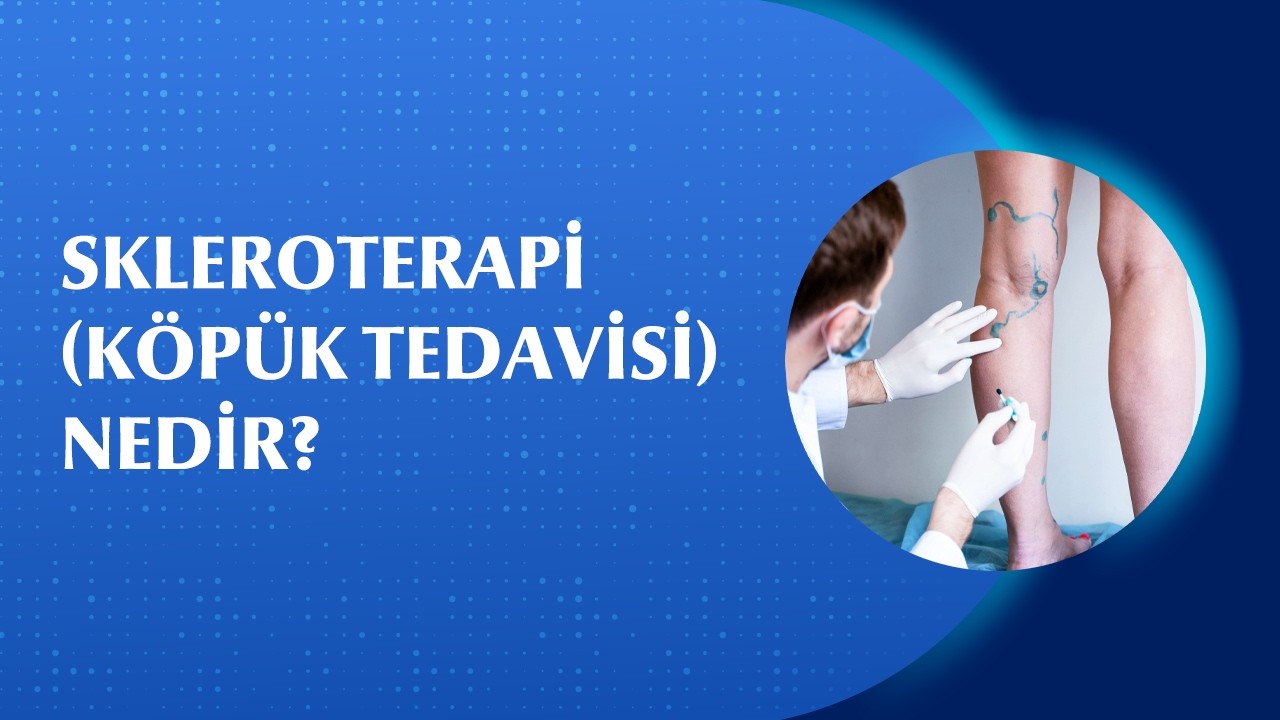 Kılcal Varis Tedavisinde Köpük Yöntemi (Skleroterapi) Nasıl Uygulanır?