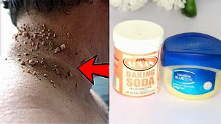 DIY skin tag removal in 3 days skin tag removal challenge natural remedy