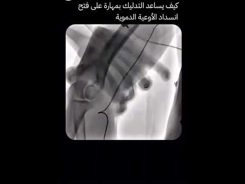 هكذا يساعد التدليك على فتح انسداد الأوعية #explore#اكسبلور#trending#ترند#tiktok#shorts#علاج#قرآن#حب