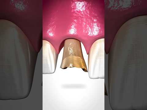 Bone Grafting Explained 🤔