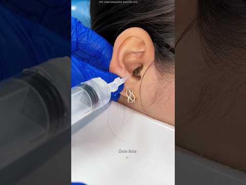 If you have any ear problems, consult a doctor.#shortsvideo #ytshorts