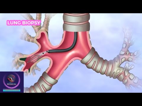 Lung Biopsy Procedure | Diagnose of Lung Disease |