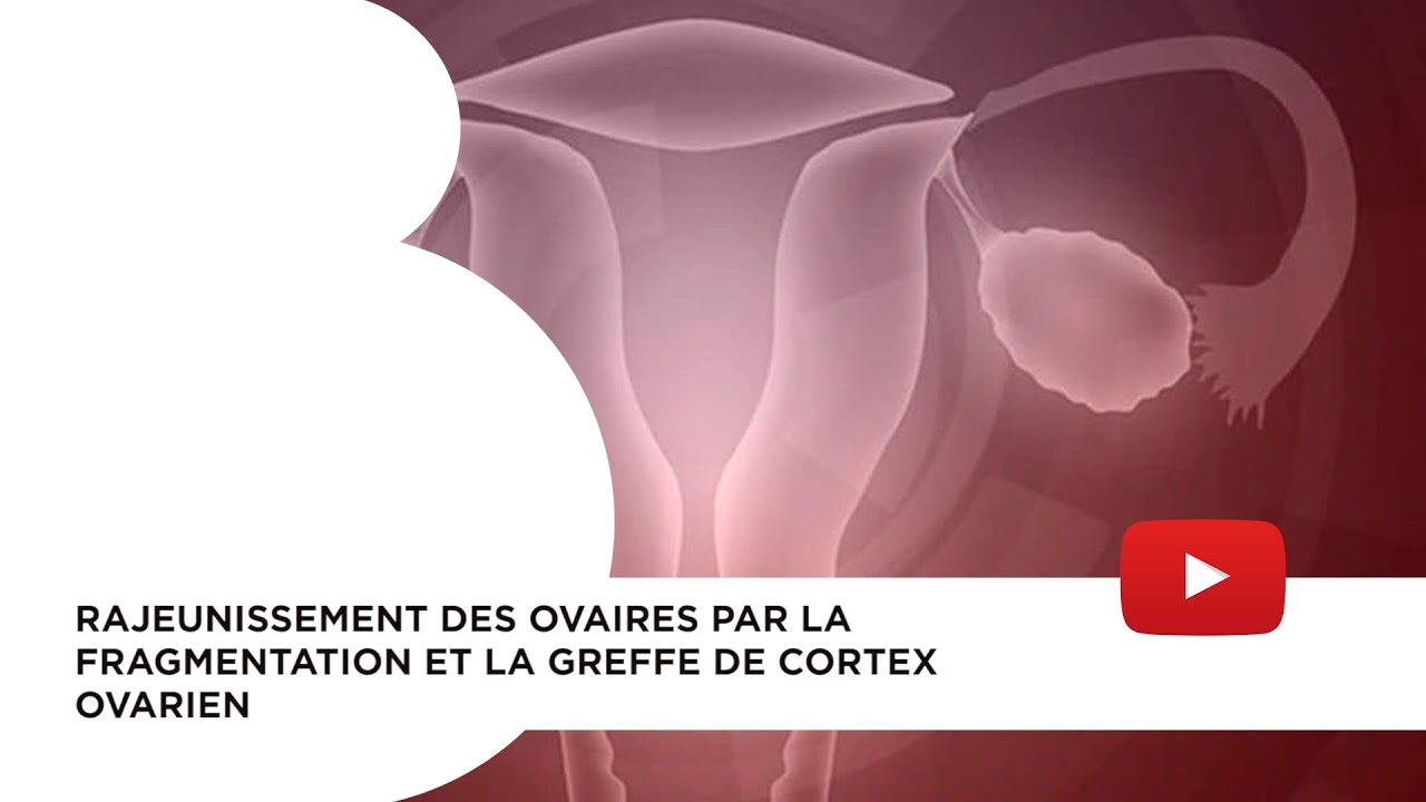 Techniques de rajeunissement ovarien. Fragmentation du cortex ovarien