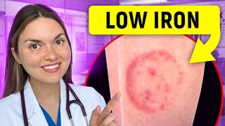 14 Signs of IRON DEFICIENCY You Can See: Doctor Explains