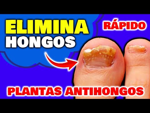 6 Plantas ASOMBROSAS para MATAR y ELIMINAR HONGOS UÑAS PIES y Uñas AMARILLAS | Remedios Caseros