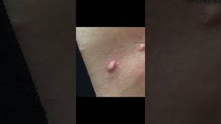 Dr. Pimple Popper Takes On a Tough Cyst