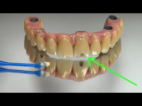 SYTON 7-Star | Enmascaramiento de un Orificio de Acceso Facial Central Anterior