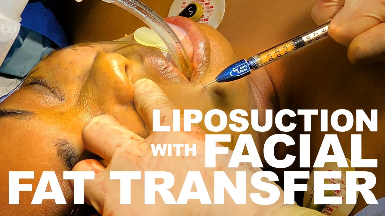 Surgical procedure: liposuction and fat transfer