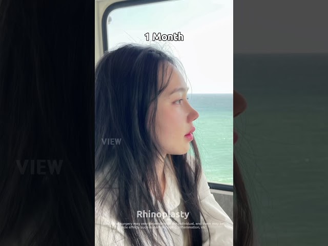 Review 1 month after nose surgery in Korea #plasticsurgery #nosesurgery #korea #seoul #nosejob #fyp