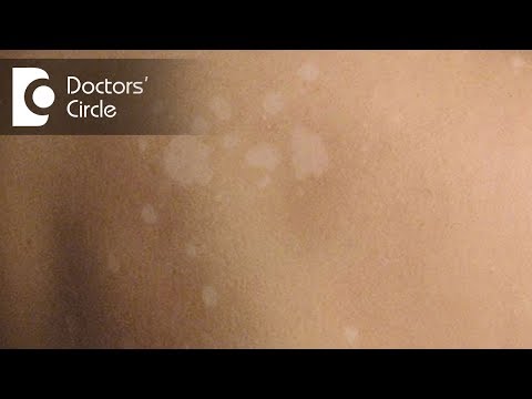 What causes white spots on skin which require investigations for confirmation? - Dr. Nischal K