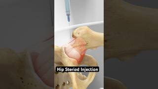 Inside a Hip Steroid Injection