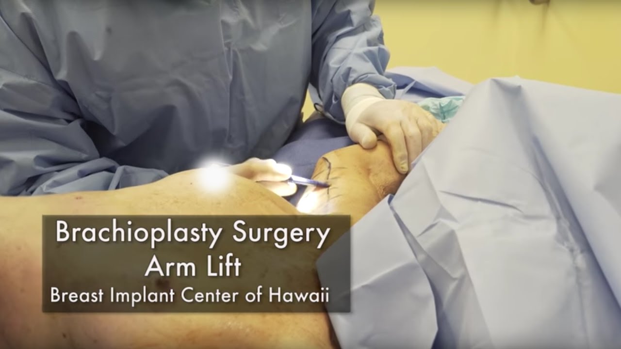 Arm Lift (Brachioplasty) Surgery at The Breast Implant Center of Hawaii - Breast Implant Center of Hawaii