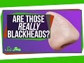 Understanding Skin and Blackheads