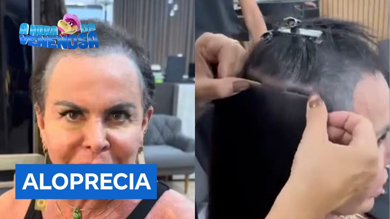 Gretchen inspira mulheres ao abordar alopecia nas redes