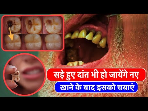 सड़े हुए दांत भी हो जायेंगे नए - खाने के बाद इसको चबाएं | Tooth Decay and Cavities DIY