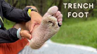 How I got TRENCH FOOT and what happened next