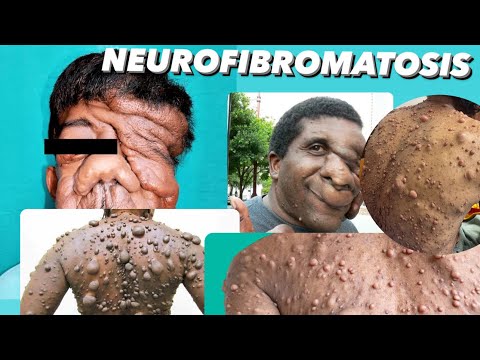 NEUROFIBROMATOSIS atau MANUSIA KUTIL ‼️MENULAR ATAU TIDAK ?