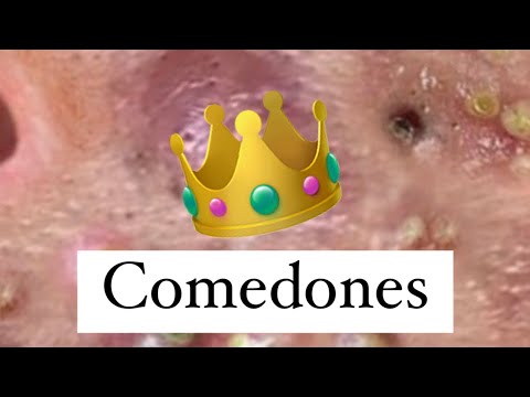 Comedones